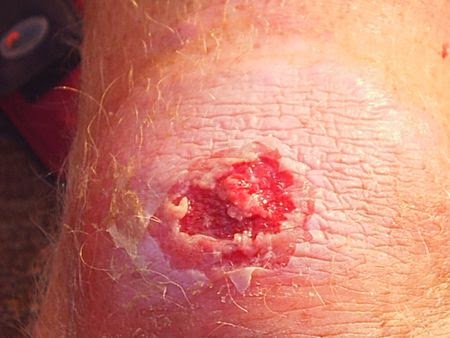 Las plantas medicinales a la psoriasis